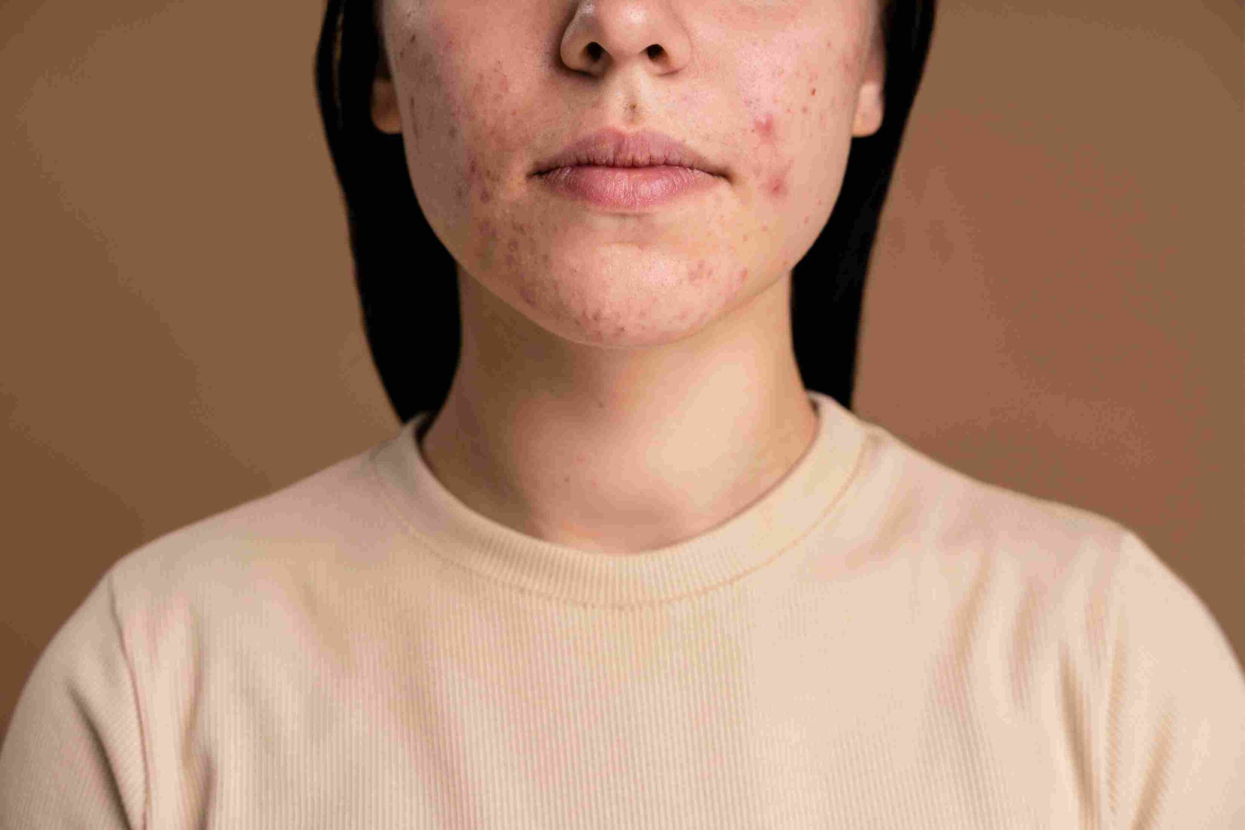 confident young woman with acne close up 11zon scaled