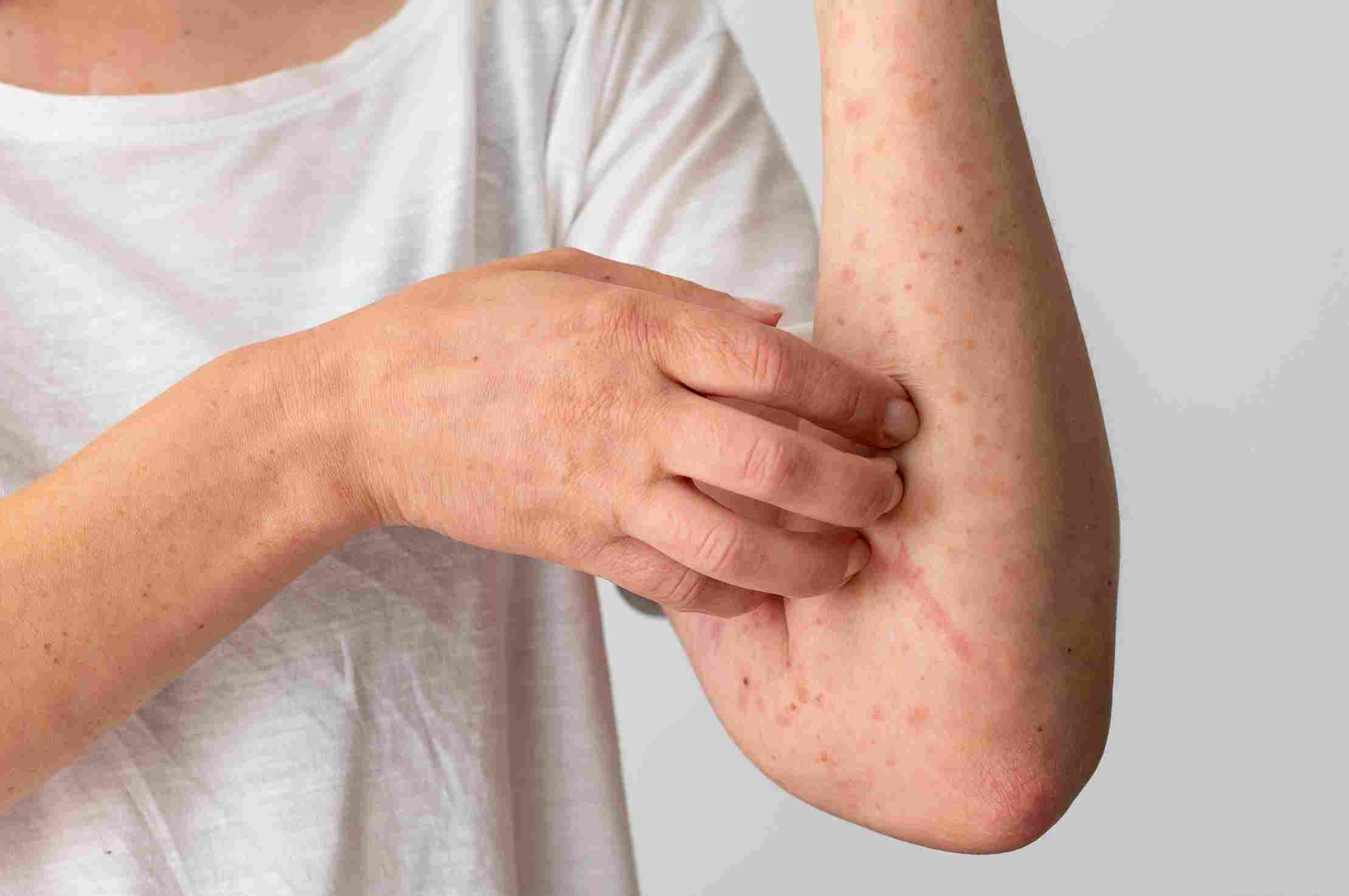 skin allergy reaction person s arm 11zon