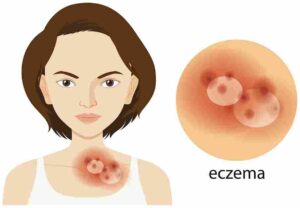 Treatment for Eczema