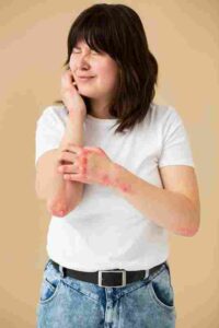 psoriasis causes severe itching and burning.