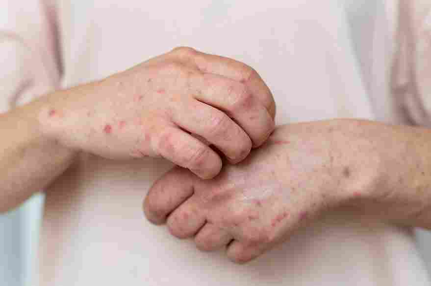 skin allergy person s arm 11zon