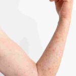 skin allergy reaction test person s arm 11zon