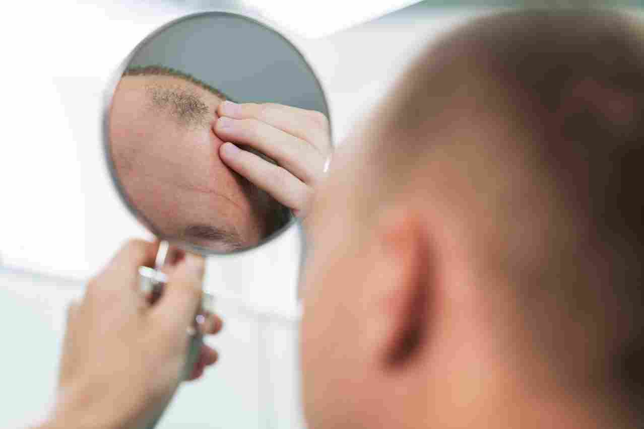 adult male having balding problems 11zon