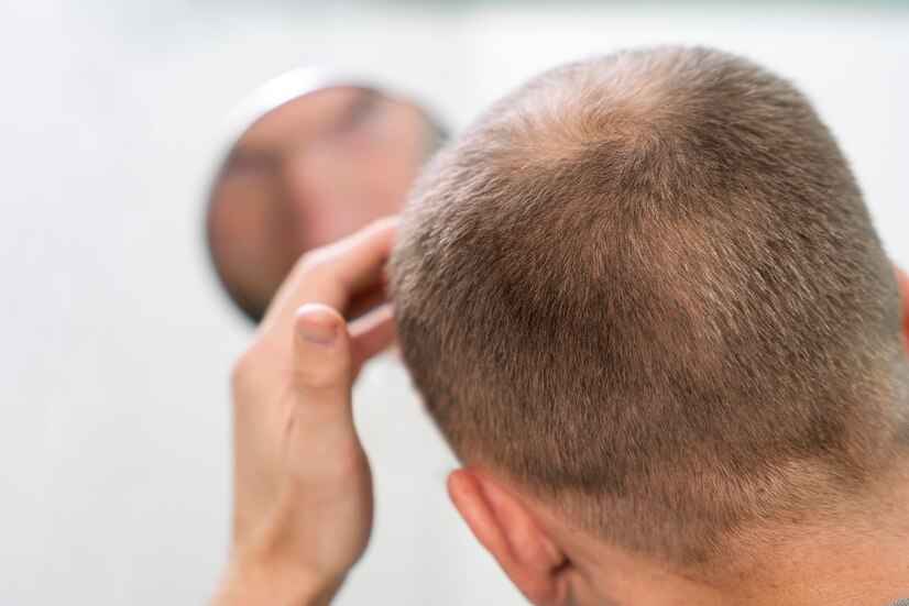 adult male having balding problems 23 2149152796 11zon