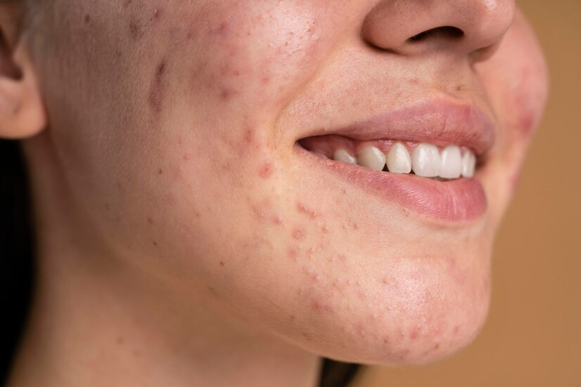Acne Treatment in Dharwad
