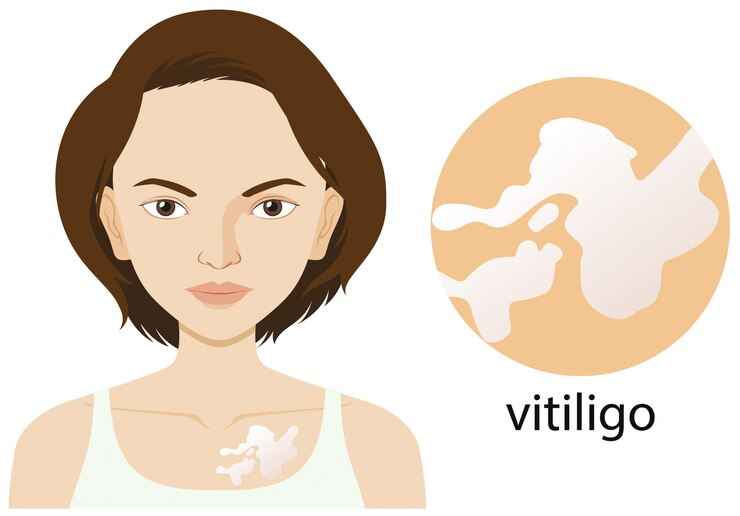 woman with vitiligo condition 1308 38399 11zon