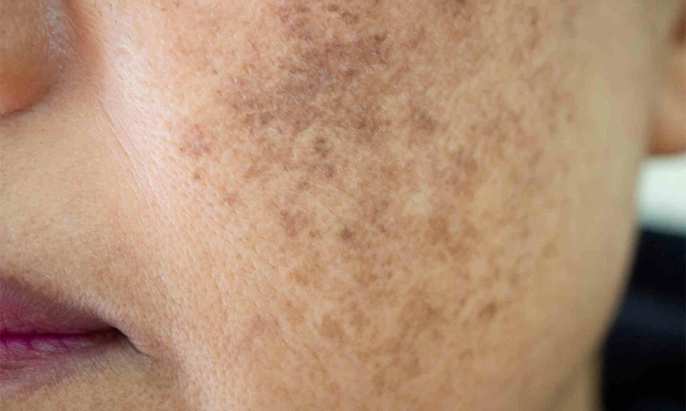 skin pigmentation treatment in Dharwad 
