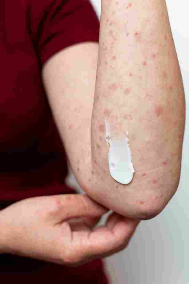 skin allergy person s arm 11zon