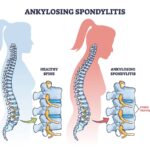 Ankylosing Spondylitis Treatment in Dharwad