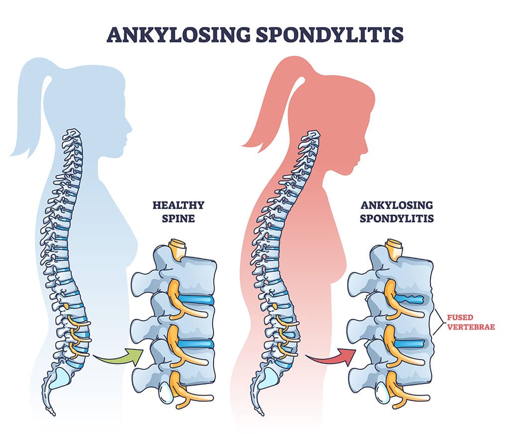 Ankylosing Spondylitis Treatment in Dharwad