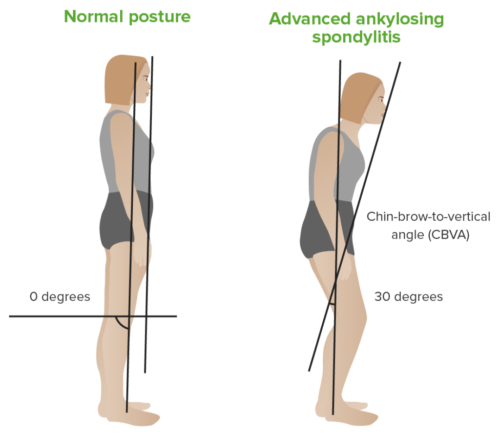 Ankylosing Spondylitis Treatment in Dharwad