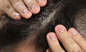 Dandruff Treatment in Dharwad