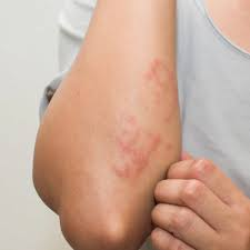 Skin Problems Treatment In Dharwad 