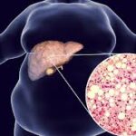 Fatty Liver Disease Treatment in Dharwad