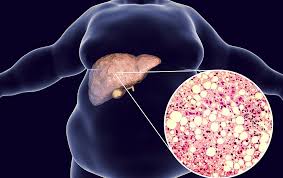 Fatty Liver Disease Treatment in Dharwad