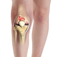 knee arthritis treatment in Dharwad 