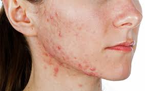 acne scars treatment in Dharwad