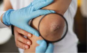 natural psoriasis management in Dharwad 